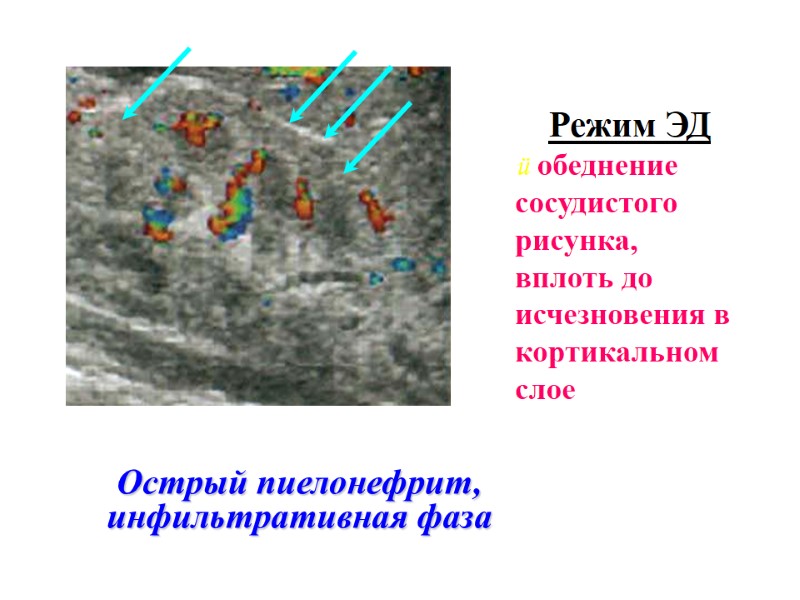 Острый пиелонефрит, инфильтративная фаза Режим ЭД  обеднение сосудистого рисунка, вплоть до исчезновения в